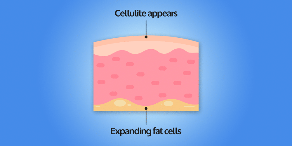 cellulite-formation-tablet